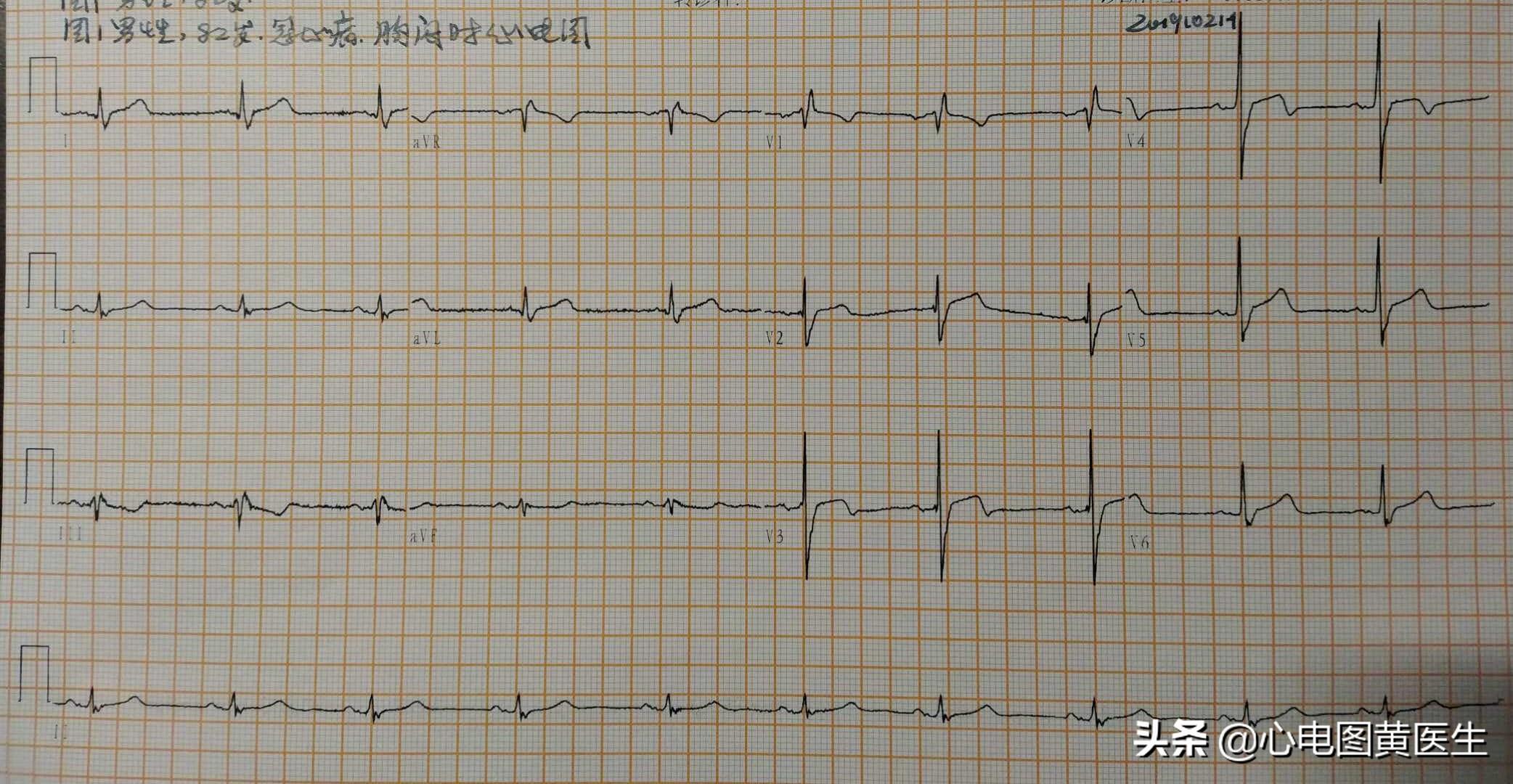 三个月胎心166次/分是否正常？解读孕期胎儿心率变化